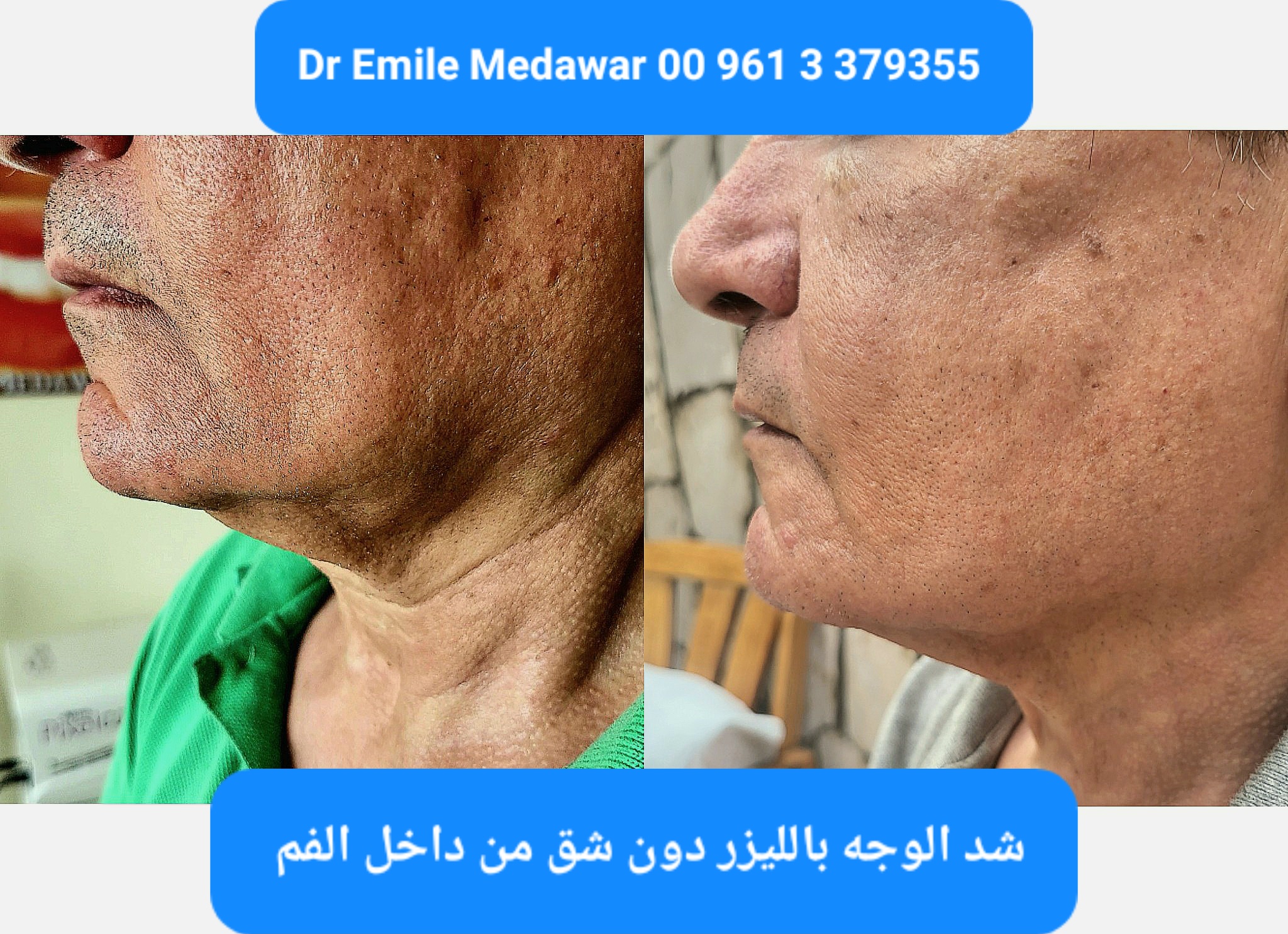 Laser Face Lift Beirut