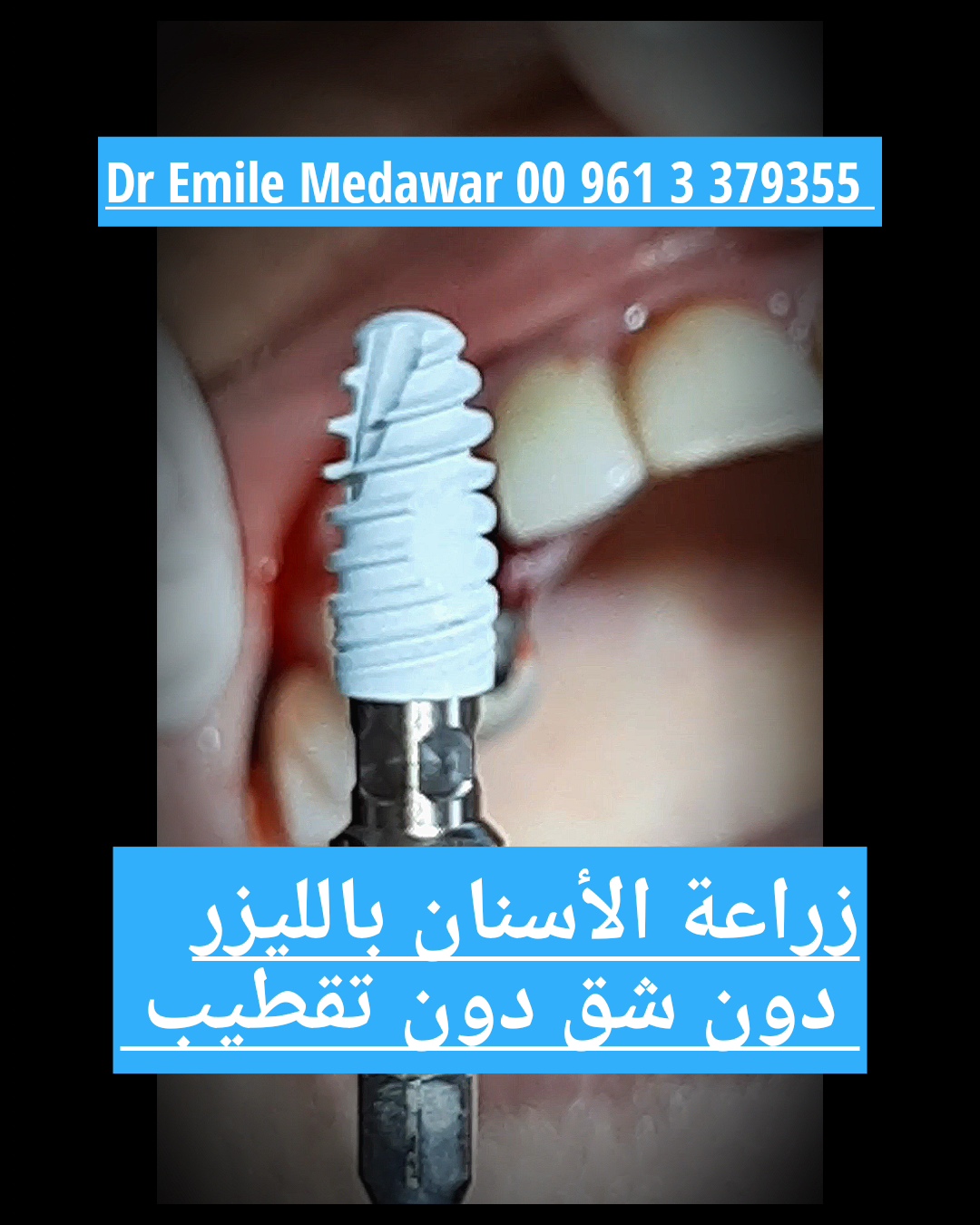 Advanced Dental Implant Clinic in Beirut