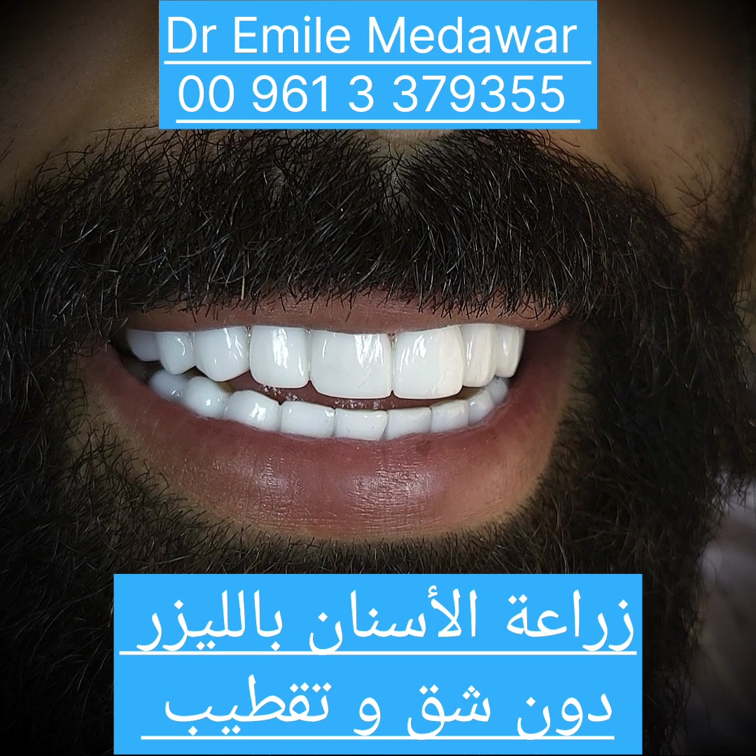 Dental Implants in Lebanon