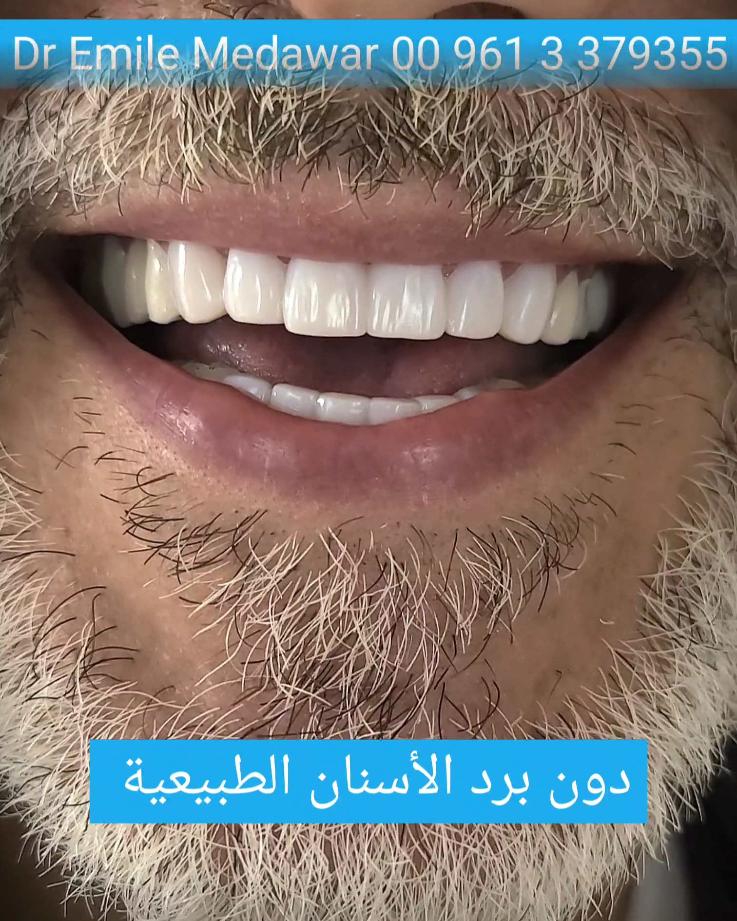 Laser Dental Implants in Lebanon