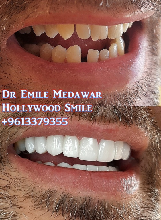 veneers lebanon beirut