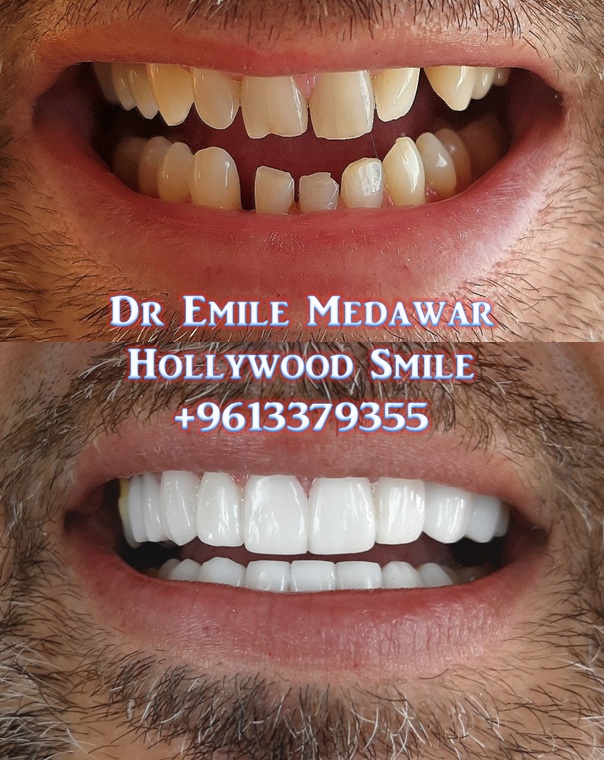 Before and after E-Max veneers in Beirut clinic