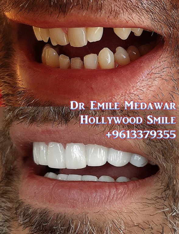 veneers lebanon